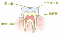 CO　ごく初期の虫歯