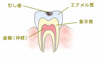 C1　エナメル質まで進行した虫歯