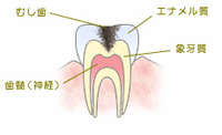 C2　象牙質まで進行した虫歯