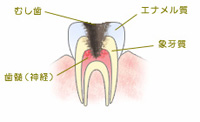 C3　神経まで達した虫歯