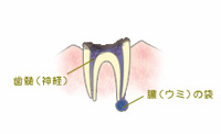 C4　歯根まで達した虫歯