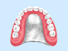 金属床義歯