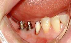 歯を失った際のインプラント治療