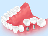 インプラント