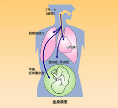 歯周病のこわさ